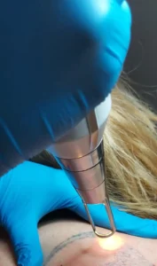 Zabieg laserowego usuwania tatuażu w Gdyni