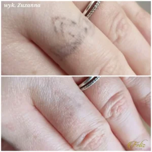 efekt laserowego usuwania tatuażu na dłoni
