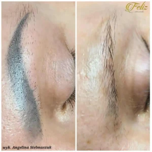 efekt laserowego usuwania makijażu permanentnego